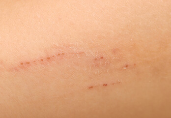 Fototapeta premium scratches on the skin of the hand as a background