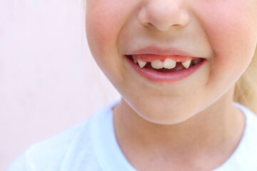 Child has crooked teeth. Baby teeth fell out.