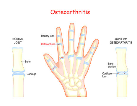 osteoarthritis. Bones of a human hand