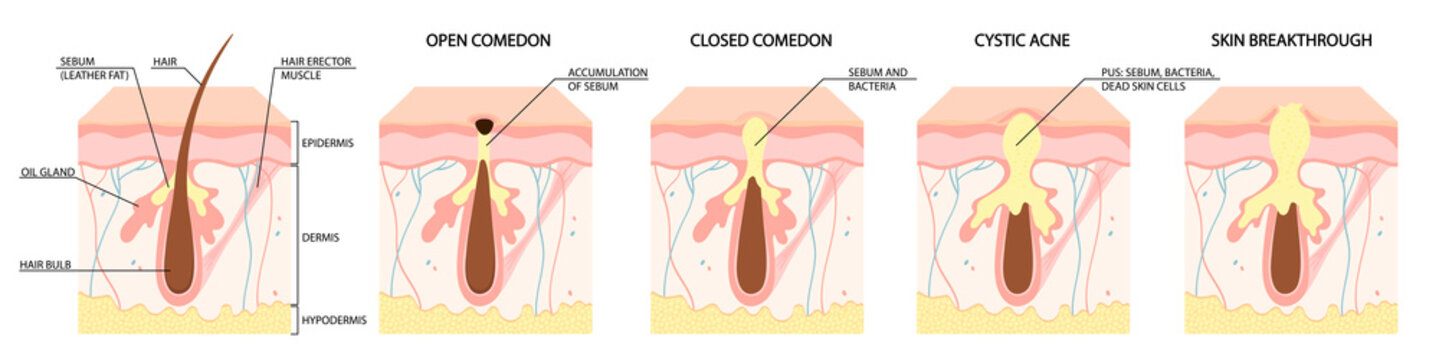 Types of acne. Open comedones, closed comedones, inflammatory acne, cystic acne. Healthy skin care concept