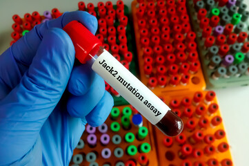 Obraz premium Scientist hold blood sample for Jack2 mutation test, To help diagnose bone marrow disorders known as myeloproliferative neoplasms (MPNs)