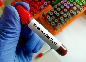 Obraz premium Rose waaler test is a haemagglutination slide test for the rapid qualitative and semi-quantitative détection of IgM Rheumatoid Factor in sera from most patients with rheumatoid arthritis.
