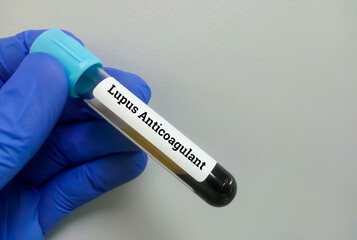 Fototapeta premium Blood Sample for Lupus Anticoagulant (LA). Blood coagulation testing. Medical or health concept