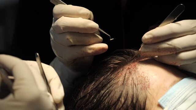 Macrophotography of a hair bulb transplanted into a hairless area. Baldness treatment. Hair transplant. Surgeons in the operating room carry out hair transplant surgery. Surgical technique that moves