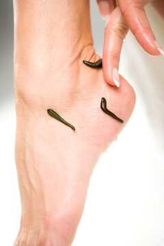 Leech therapy with medical leeches on human body. Naturopathy, healthcare, natural medicine, good blood circulation.