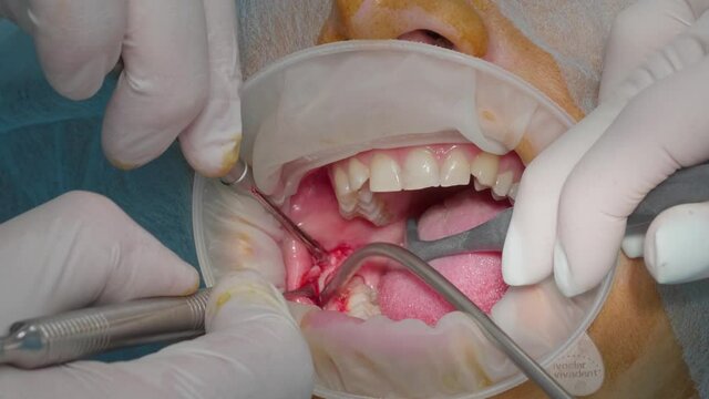Dentist surgeon shows wisdom tooth close up