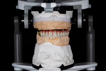 ceramic prosthesis of the upper jaw with models of jaws in the articulator on a black background © Dental Pro Content