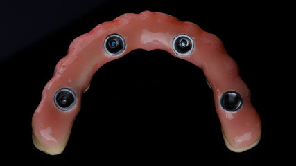 dental prosthesis made of ceramic and titanium of the upper jaw top view on a black background © Dental Pro Content