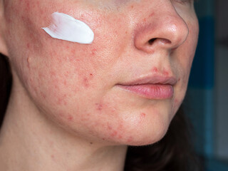 medicated ointment on woman face with rosacea close up