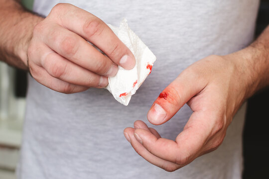 The cut finger is bleeding