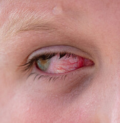 Fototapeta na wymiar Close up of a boy's red eyes.