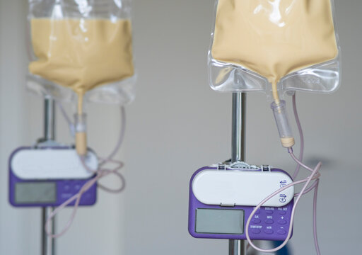 Couple of feeding pump medical device purple color to supplement nutrition liquid food to tube enteral feeding fluid set bag with clamp hanging on stand.