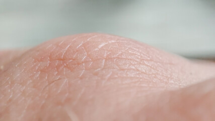 dermatology concept. Details of human skin background. Close-up skin dermatilis. Caucasian hand