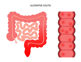 intestine ulcerative colitis - obrazy, fototapety, plakaty