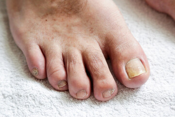 Details of man nails with fungal infection known as mycosis, natural light