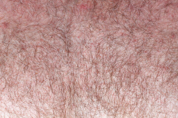 Brown and gray hair on the male chest. Red pimples on the very hairy men’s breast. Naked man at the doctor's appointment. Medical examination nude man's bosom. Close-up
