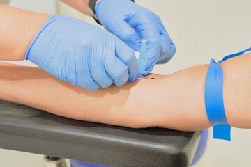 Nurse takes a blood sample, with a prick on the forearm of a patient. Rapid antibody diagnostic procedure.Steps in the process of a serology, antibodies and immunity - obrazy, fototapety, plakaty