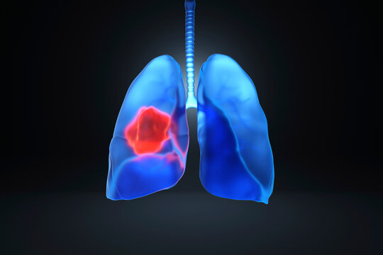 Digitally generated image of lungs with cancer