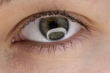 Green pupil with a dark spot on the lining of the eye. Injury to the eye.