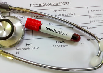 Blood sample tube with stethoscope on abnormal high IL-6 (Interleukin-6) test result report. Covid-19 patient condition monitoring test