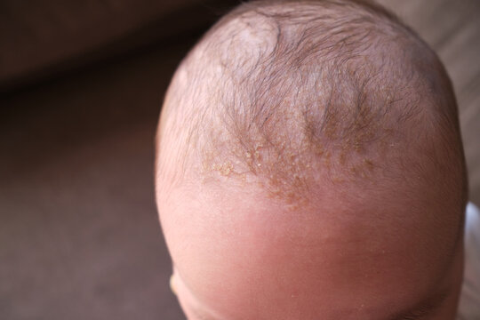 Cradle cap (seborrheic dermatitis) on the head of babies