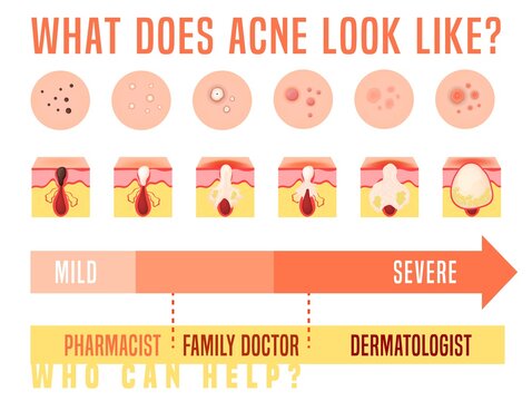 Acne types set. Skin disease, dermatology, cosmetology concept.