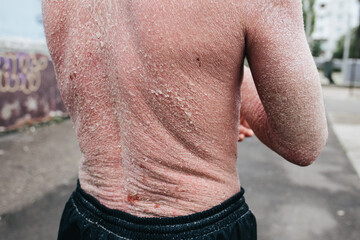 A man with psoriasis on his back and neck. Scratch with his hand. Psoriasis vulgaris skin problem