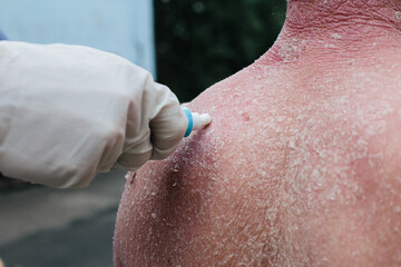 Naklejka premium A dermatologist wearing gloves examines the skin of a sick patient. Examination and diagnosis of skin diseases-allergies, psoriasis, eczema, dermatitis. The doctor applies the cream to the skin
