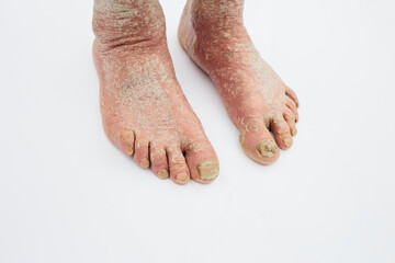 The doctor diagnoses the injured foot. Dry skin, Psoriasis of the feet. The skin is damaged. Dermatitis, eczema, psoriasis, allergic reaction. Peeling and cracking on the foot of a person.