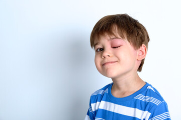 A boy with swollen eye from insect bite. Quincke edema. Portrait of Caucasian appearance child...