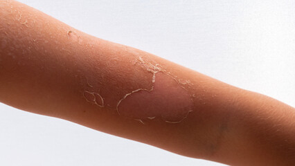 skin after sunburn. skin slips