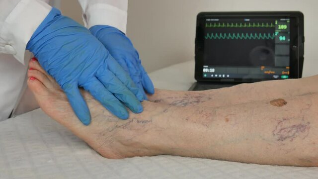 elderly patient at the doctor who checks her legs with many varicose veins
