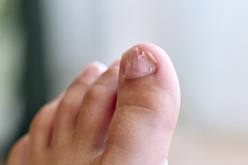 Young boy's foot with weak nails, nail disease