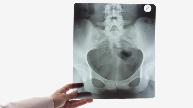 Pelvic bones scan in female hand. Doctor examines x-ray against background of light screen or negatoscope. Gradual focusing.