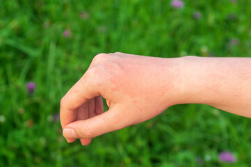 A red hot sun allergy spot on the arm is usually painful or itchy.