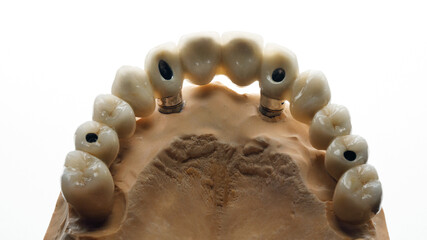 ceramic dental prosthesis of the upper jaw in the lumen © Dental Pro Content