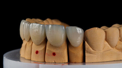 ceramic dental veneers of the upper jaw on the model with a black background