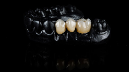black resin model jaw with three ceramic crowns on a black background