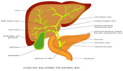 Gallstones in the gallbladder. Human liver and gallbladder anatomy. Flush out gallstones the natural way. Gallstones in the gallbladder and bile duct. Cholesterol stones and pigment stones. - obrazy, fototapety, plakaty