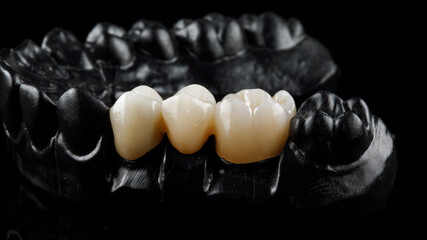 ceramic crowns in the chewing area on the black model - obrazy, fototapety, plakaty