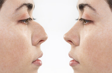 Obraz premium Two female faces close-up showing the result before and after rhinoplasty. Side view. White background. The concept of rhinoplasty