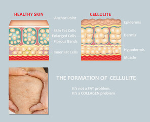 forming of underskin cellulite illustration - obrazy, fototapety, plakaty
