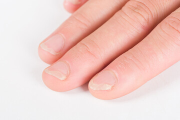 Onychomycosis or fungal nail infection on damaged nails after gel polish, onychosis. 