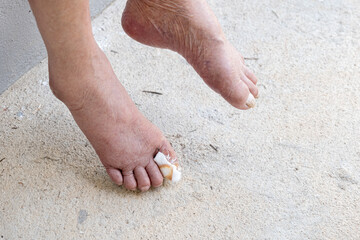 Flies swarming bandage with lymph or body fluid and blood from the foot wound of a 95 years old senior leg with paralyze problem.