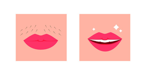 A woman's mustache is above the upper lip. Smile and clear skin without hair and mustache. Concept: getting rid of facial hair. Vector illustration, flat cartoon color design, eps 10.