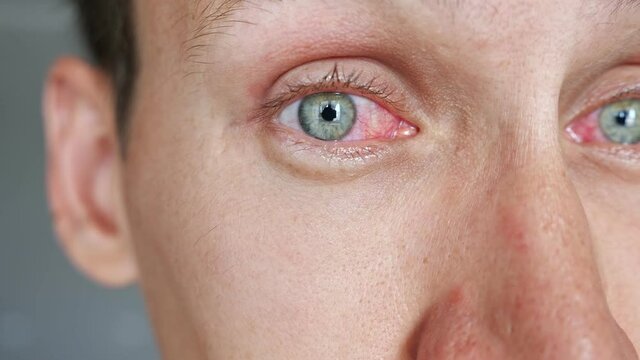 Close-up of a male face with red eyes.