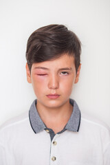 A boy with swollen eye from insect bite. Quincke edema.
