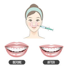 ガミースマイル　治療