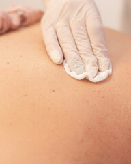 Preparing skin for lipolytic injections. Skin Disinfection  before cosmetic procedures