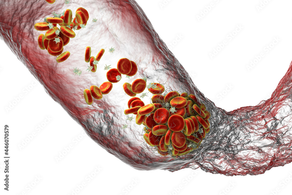 Sticker blood clot made of red blood cells, platelets and fibrin protein strands. thrombus